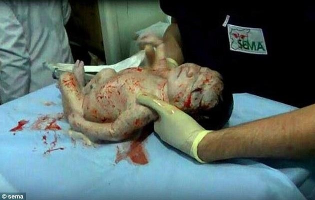 Сирийские врачи спасли раненную в голову шрапнелью новорожденную и ее маму