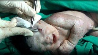 Сирийские врачи спасли раненную в голову шрапнелью новорожденную и ее маму